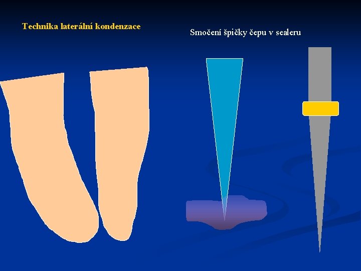 Technika laterální kondenzace Smočení špičky čepu v sealeru 