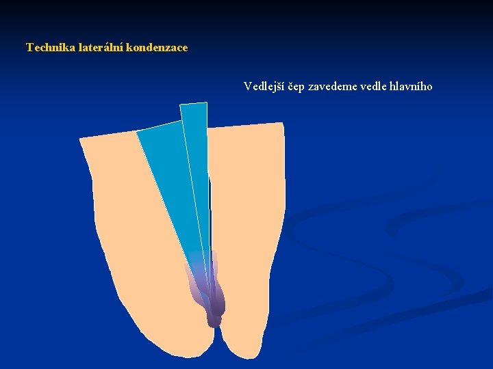 Technika laterální kondenzace Vedlejší čep zavedeme vedle hlavního 