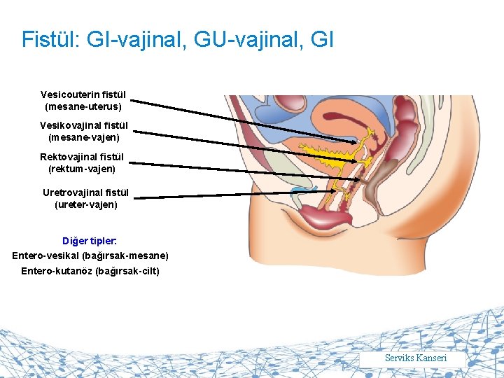 Fistül: GI-vajinal, GU-vajinal, GI Vesicouterin fistül (mesane-uterus) Vesikovajinal fistül (mesane-vajen) Rektovajinal fistül (rektum-vajen) Uretrovajinal