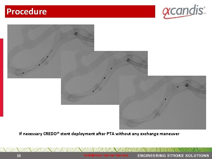 Procedure If necessary CREDO® stent deployment after PTA without any exchange maneuver 14 Confidential: