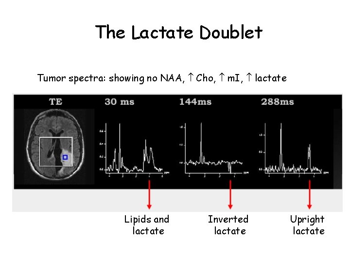 The Lactate Doublet Tumor spectra: showing no NAA, Cho, m. I, lactate Lipids and