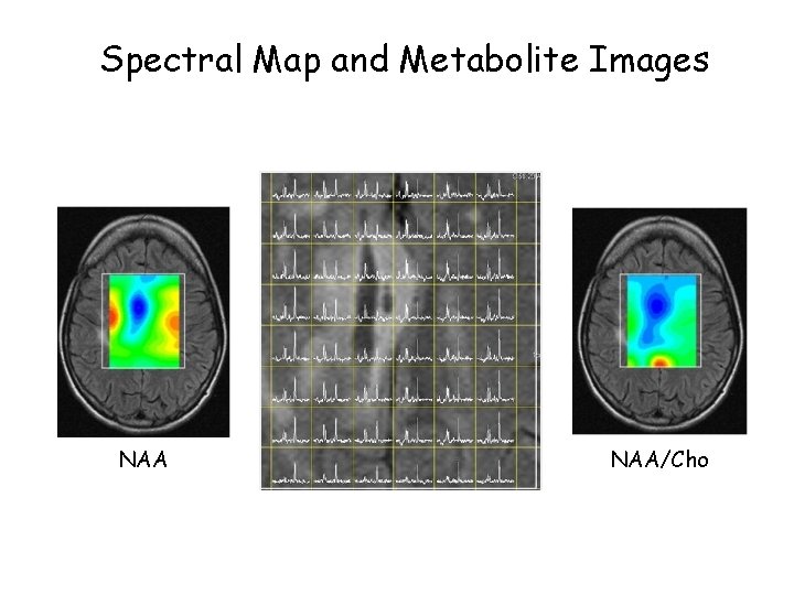 Spectral Map and Metabolite Images NAA/Cho 