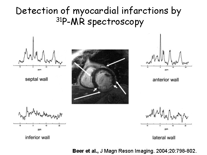 Detection of myocardial infarctions by 31 P-MR spectroscopy Beer et al. , J Magn