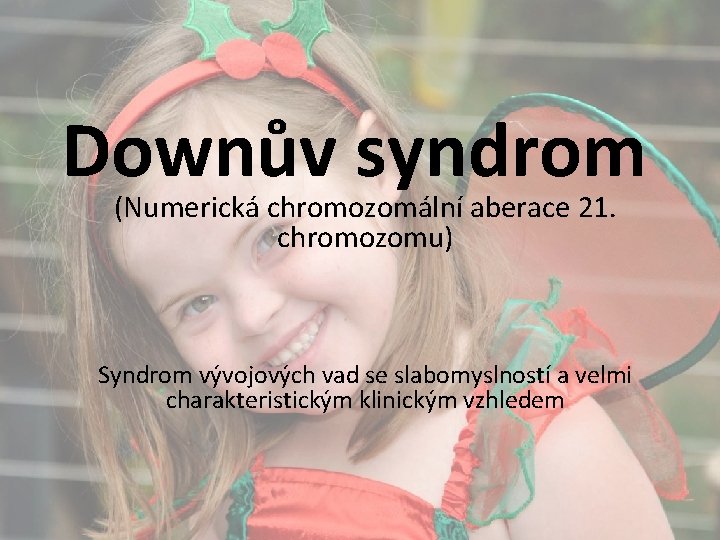 Downův syndrom (Numerická chromozomální aberace 21. chromozomu) Syndrom vývojových vad se slabomyslností a velmi