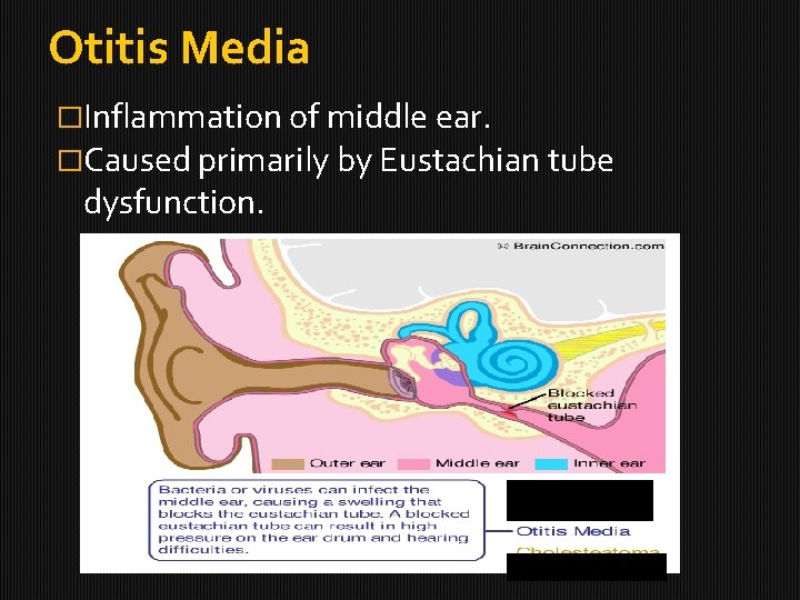 Otitis Media �Inflammation of middle ear. �Caused primarily by Eustachian tube dysfunction. 