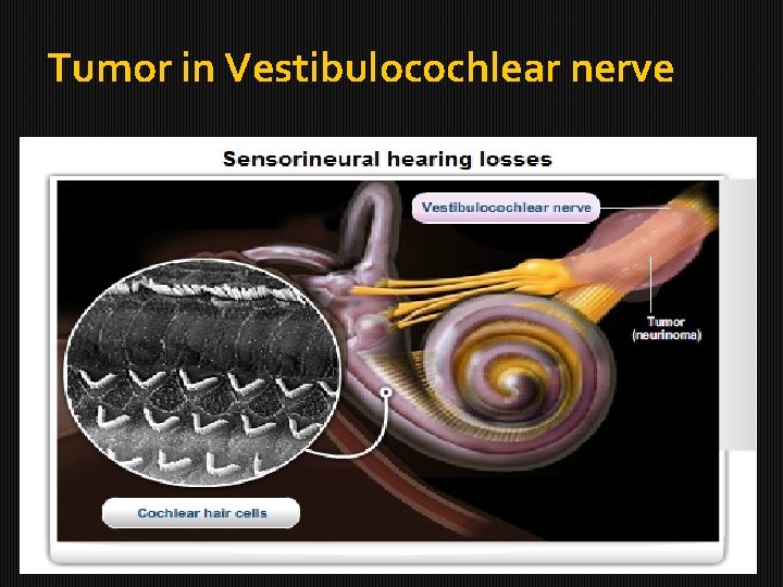 Tumor in Vestibulocochlear nerve 