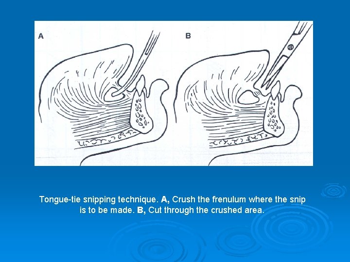 Tongue-tie snipping technique. A, Crush the frenulum where the snip is to be made.