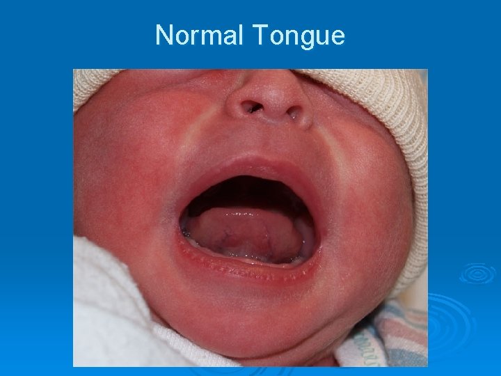 Normal Tongue 