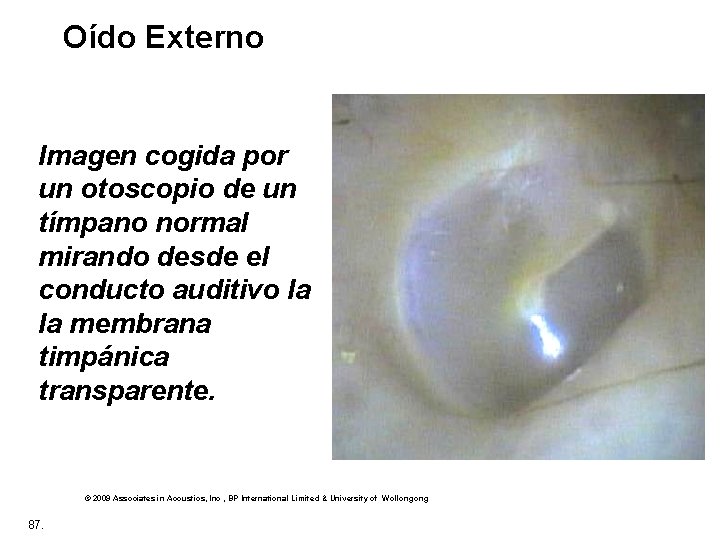 Oído Externo Imagen cogida por un otoscopio de un tímpano normal mirando desde el