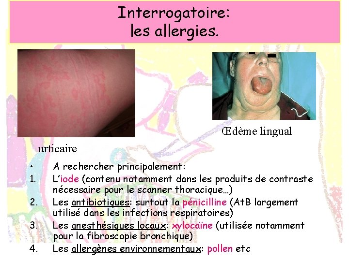 Interrogatoire: les allergies. Œdème lingual urticaire • 1. 2. 3. 4. A recher principalement: