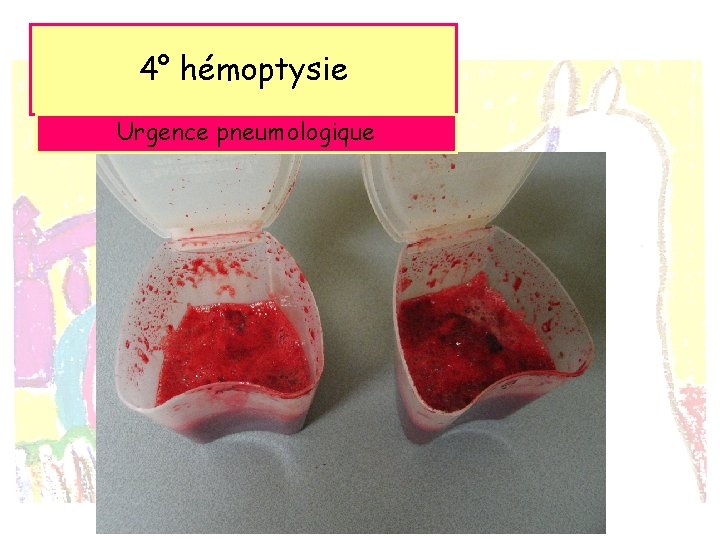 4° hémoptysie Urgence pneumologique 