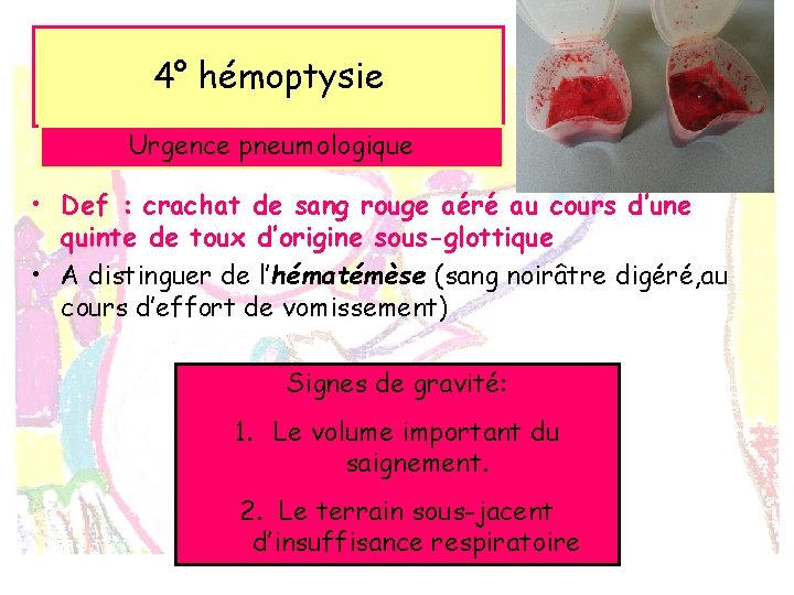 4° hémoptysie Urgence pneumologique • Def : crachat de sang rouge aéré au cours