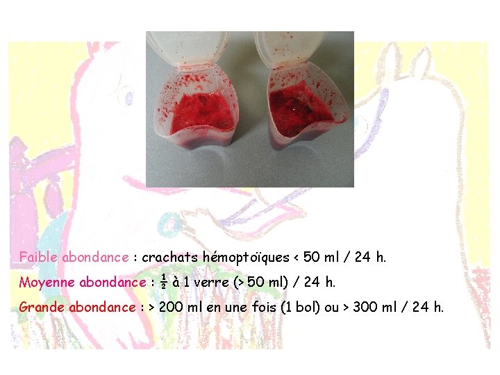 Faible abondance : crachats hémoptoïques < 50 ml / 24 h. Moyenne abondance :