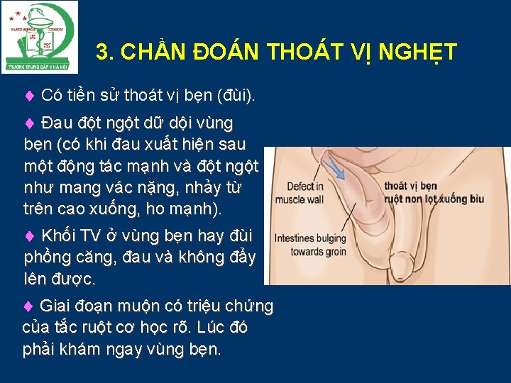 3. CHẨN ĐOÁN THOÁT VỊ NGHẸT Có tiền sử thoát vị bẹn (đùi). Đau