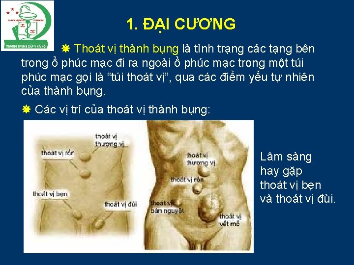 1. ĐẠI CƯƠNG Thoát vị thành bụng là tình trạng các tạng bên trong