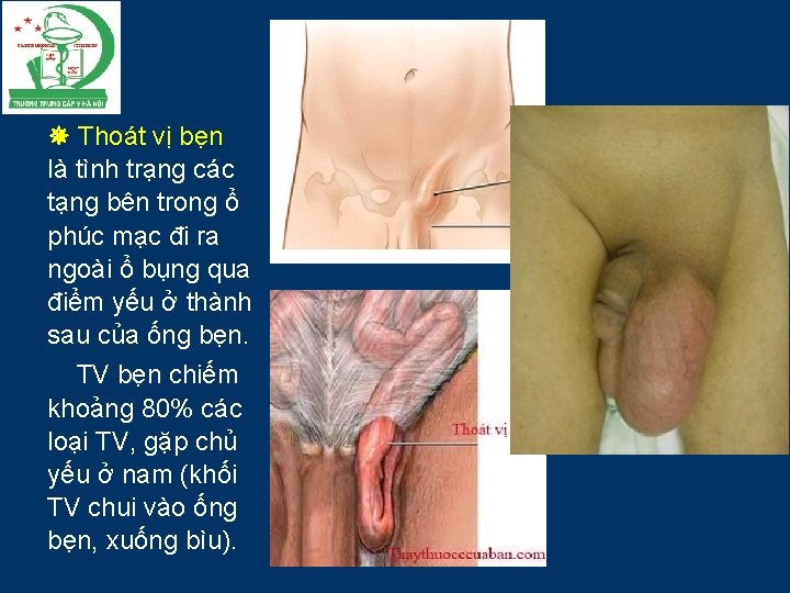  Thoát vị bẹn là tình trạng các tạng bên trong ổ phúc mạc