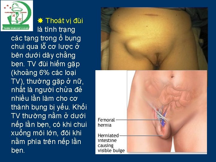  Thoát vị đùi là tình trạng các tạng trong ổ bụng chui qua