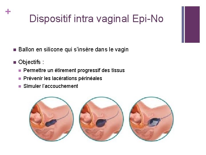 + Dispositif intra vaginal Epi-No n Ballon en silicone qui s’insère dans le vagin + Dispositif intra vaginal Epi-No n Ballon en silicone qui s’insère dans le vagin