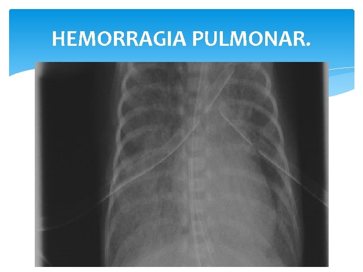 HEMORRAGIA PULMONAR. 