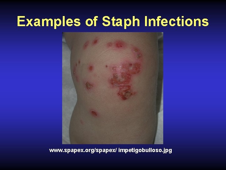 Examples of Staph Infections www. spapex. org/spapex/ impetigobulloso. jpg 