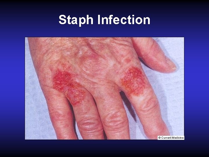 Staph Infection 