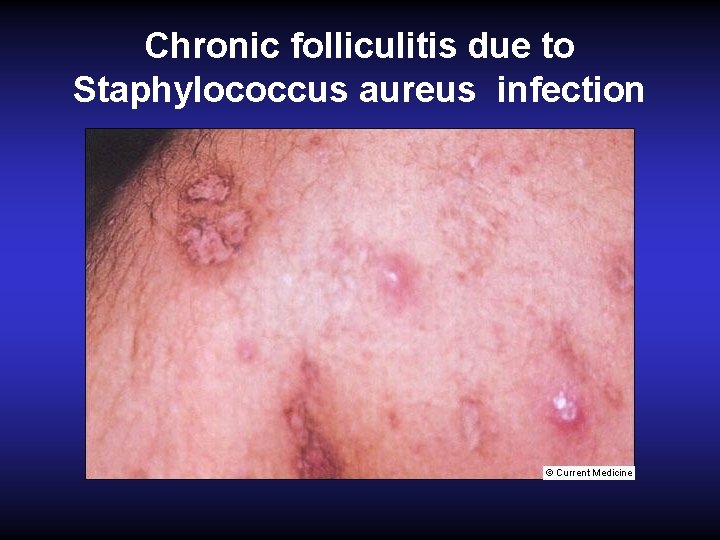 Chronic folliculitis due to Staphylococcus aureus infection 