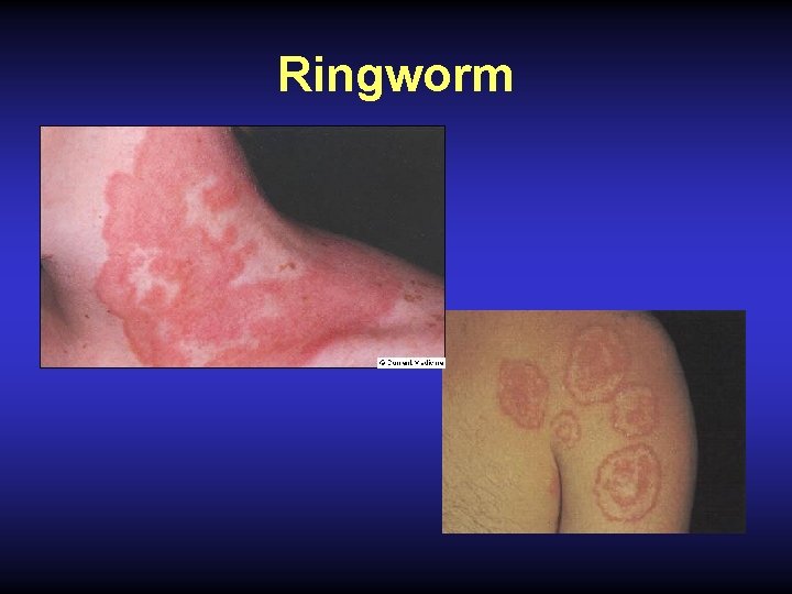 Ringworm 