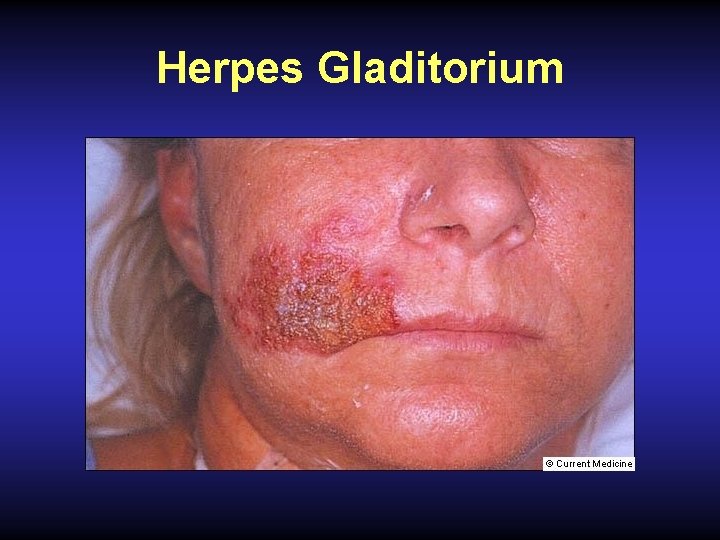 Herpes Gladitorium 