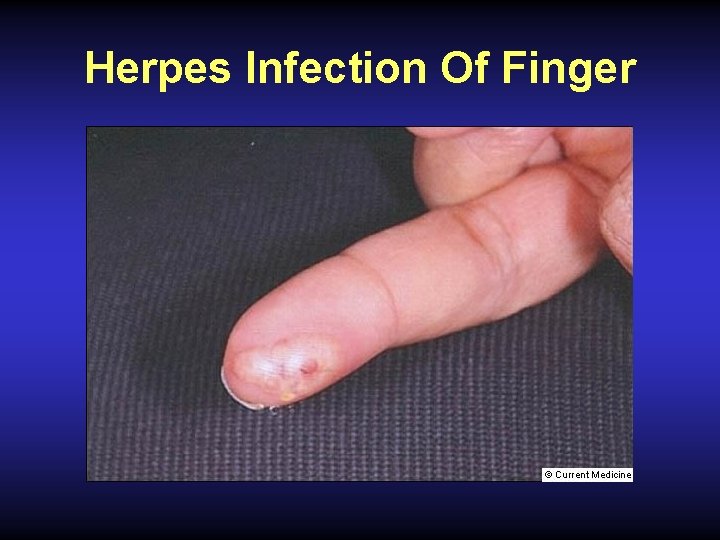 Herpes Infection Of Finger 