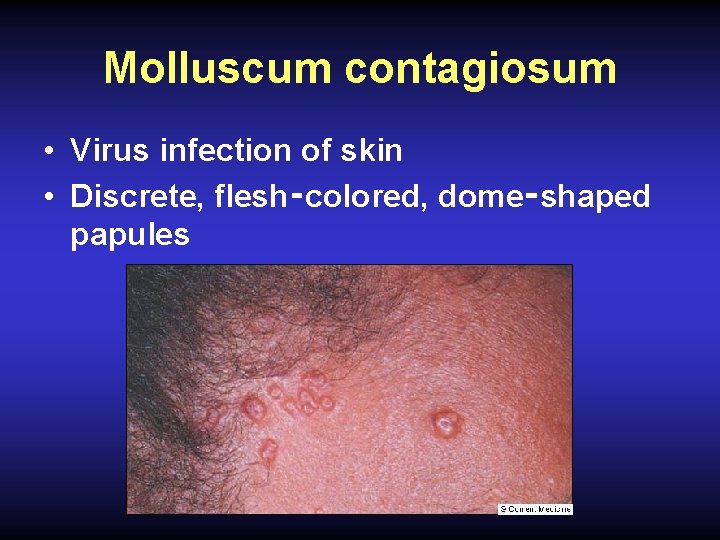 Molluscum contagiosum • Virus infection of skin • Discrete, flesh‑colored, dome‑shaped papules 