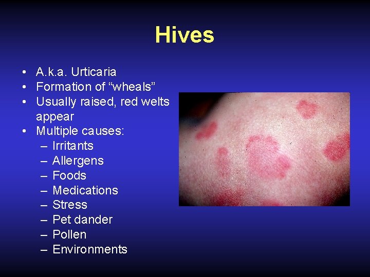 Hives • A. k. a. Urticaria • Formation of “wheals” • Usually raised, red