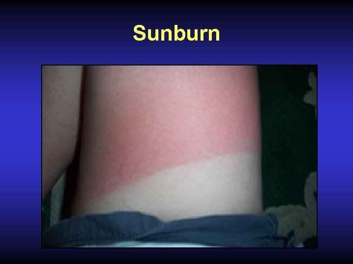 Sunburn 