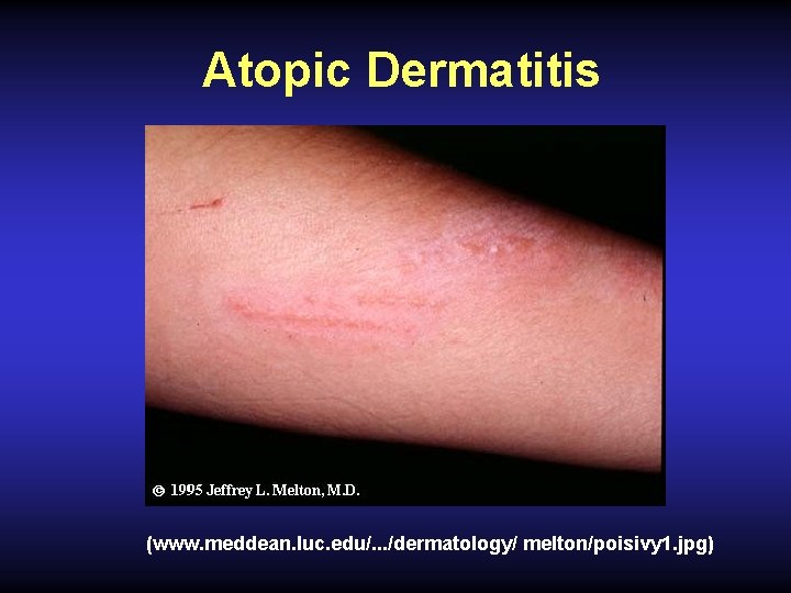 Atopic Dermatitis (www. meddean. luc. edu/. . . /dermatology/ melton/poisivy 1. jpg) 