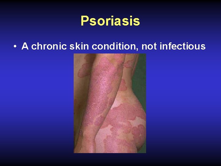 Psoriasis • A chronic skin condition, not infectious 