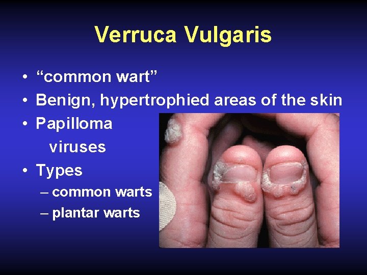 Verruca Vulgaris • “common wart” • Benign, hypertrophied areas of the skin • Papilloma