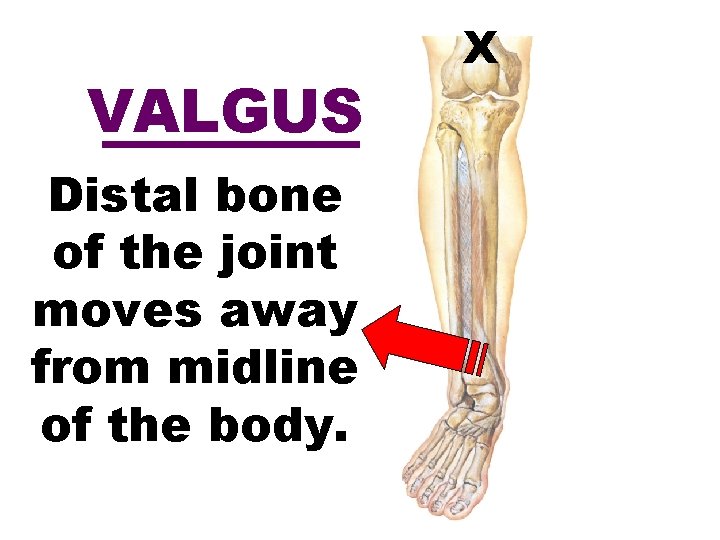 VALGUS Distal bone of the joint moves away from midline of the body. X