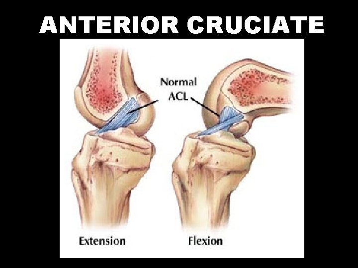 ANTERIOR CRUCIATE 