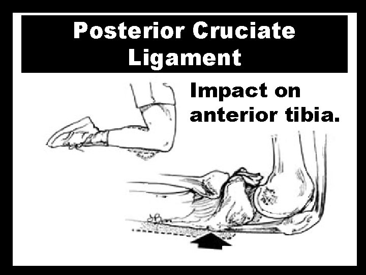Posterior Cruciate Ligament Impact on anterior tibia. 