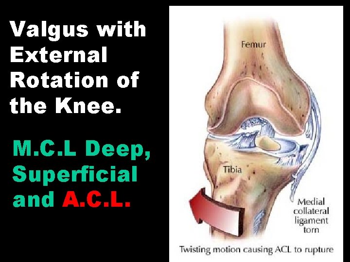 Valgus with External Rotation of the Knee. M. C. L Deep, Superficial and A.