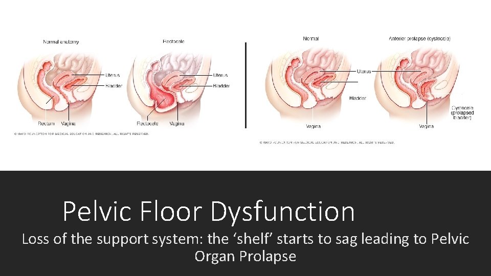 Pelvic Floor Dysfunction Loss of the support system: the ‘shelf’ starts to sag leading