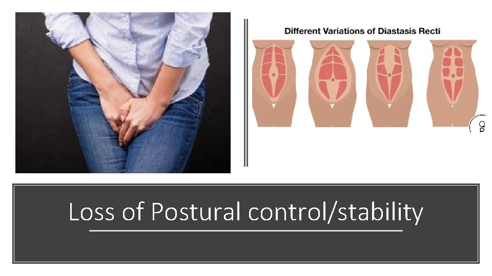 Loss of Postural control/stability 