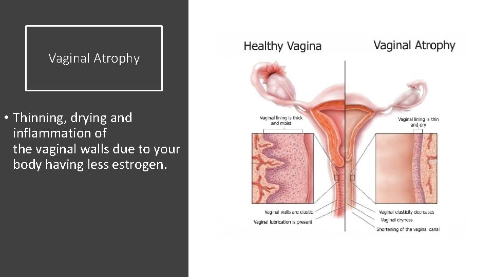 Vaginal Atrophy • Thinning, drying and inflammation of the vaginal walls due to your