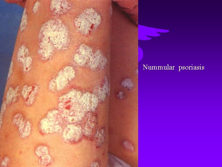 Nummular psoriasis 