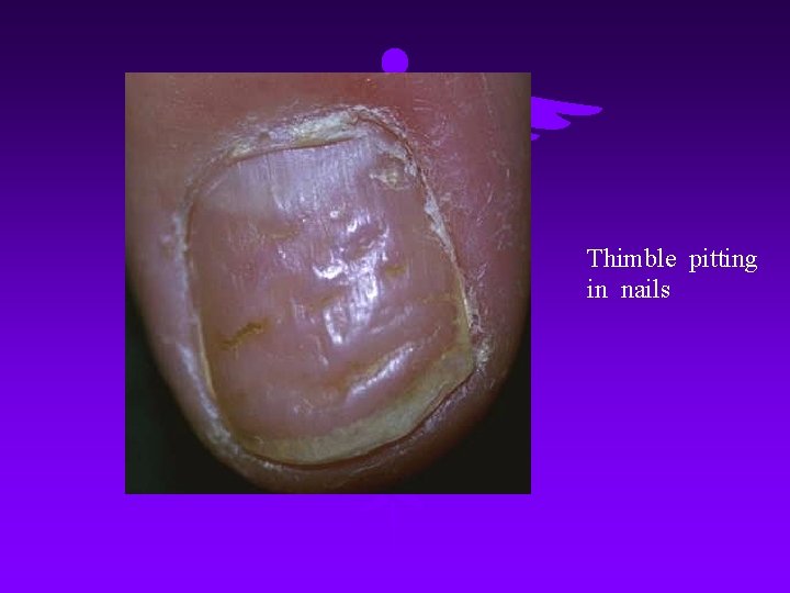 Thimble pitting in nails 