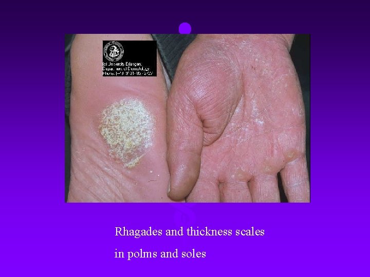 Rhagades and thickness scales in polms and soles 