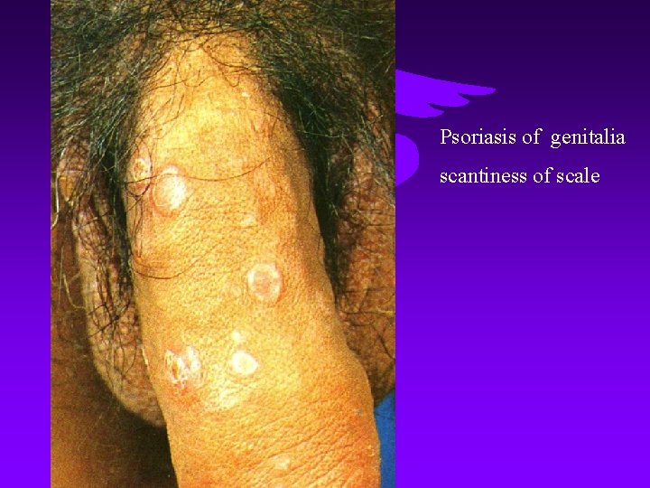 Psoriasis of genitalia scantiness of scale 