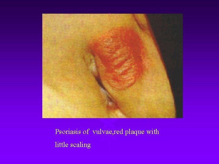 Psoriasis of vulvae, red plaque with little scaling 