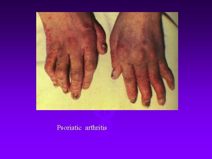 Psoriatic arthritis 