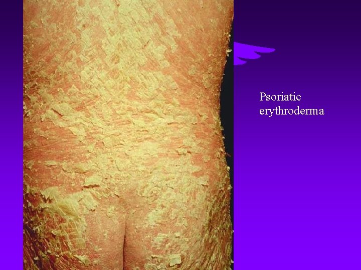 Psoriatic erythroderma 
