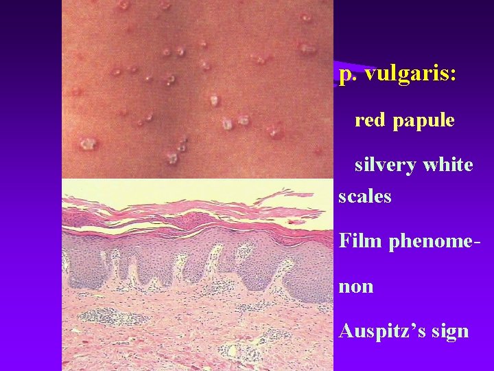 p. vulgaris: red papule silvery white scales Film phenomenon Auspitz’s sign 